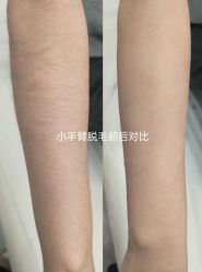 -薇兰专业脱毛连锁机构