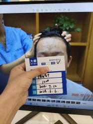 -大麦微针植发全国连锁