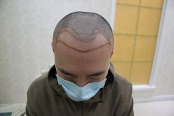 -大麦微针植发丨全国连锁