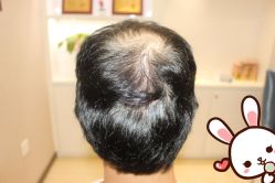 -大麦微针植发丨全国连锁