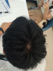 -大麦微针植发丨全国连锁
