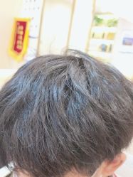 -碧莲盛·不剃发植发