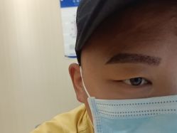-碧莲盛·不剃发植发