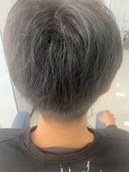 -大麦微针植发丨全国连锁