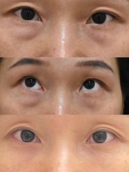 体验后-广州健丽·去眼袋医疗美容机构