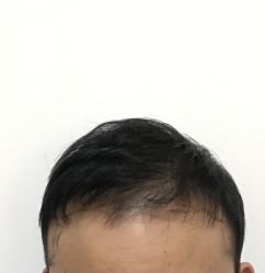 -碧莲盛·不剃发植发