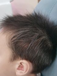 点击看大图 -碧莲盛·不剃发植发