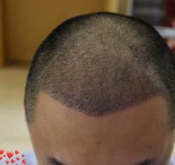 -大麦微针植发丨全国连锁