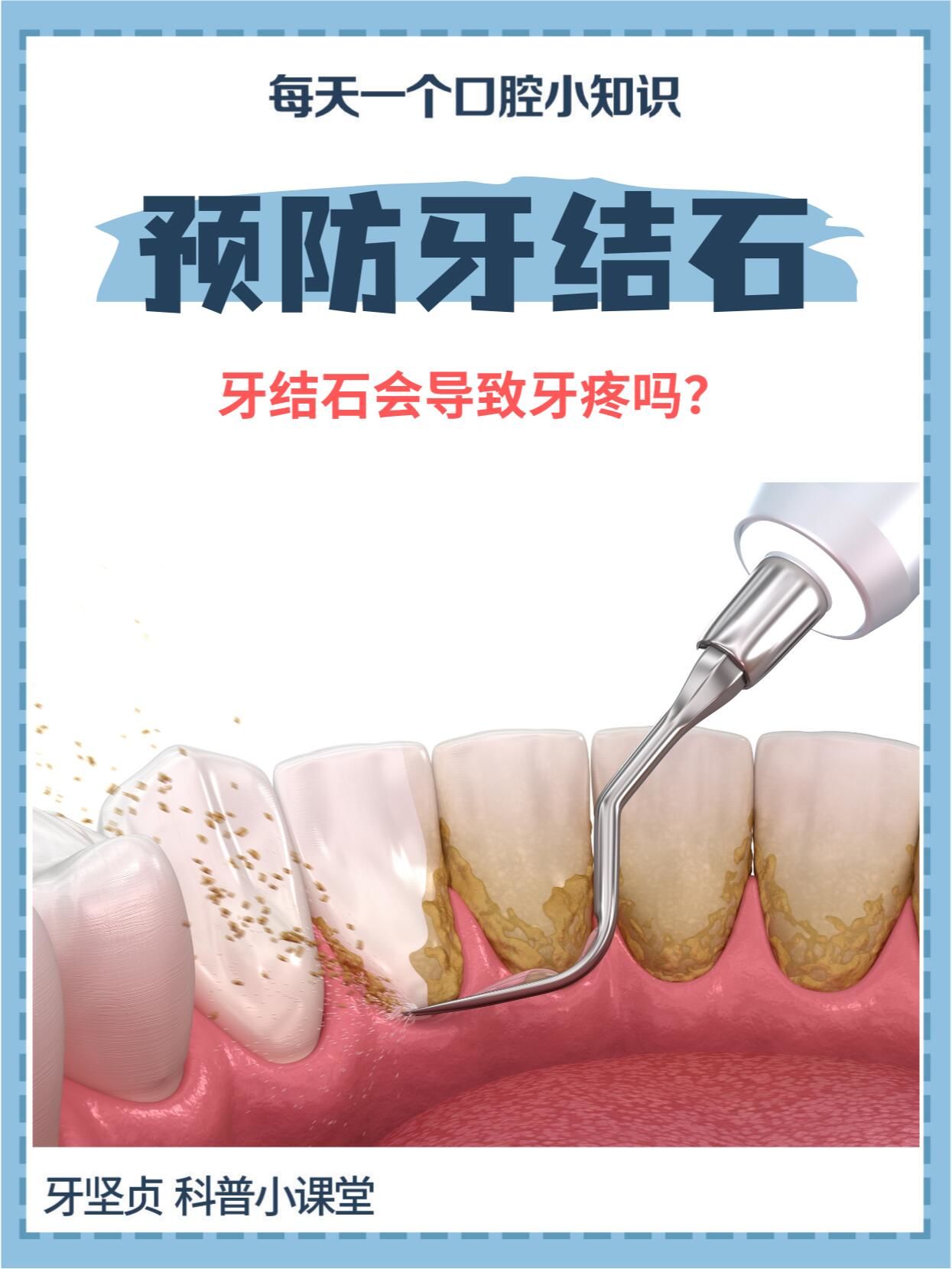 结石,又称为牙石,是沉积在牙齿或修复体表面上已钙化或正在钙化的菌斑