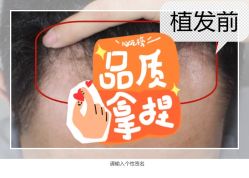 -大麦微针植发全国连锁