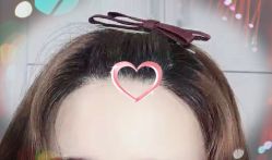 -大麦微针植发全国连锁