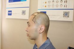 -大麦微针植发丨全国连锁