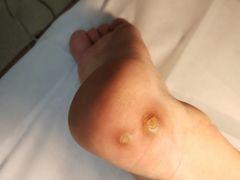 -世龙世家灰指甲鸡眼脚气甲沟炎跖疣护理(通州店)