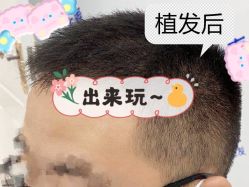-大麦微针植发全国连锁