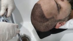 -大麦微针植发全国连锁