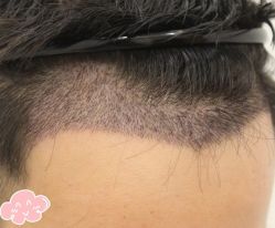 -大麦微针植发丨全国连锁