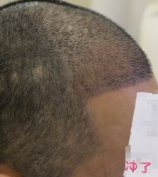 -大麦微针植发丨全国连锁