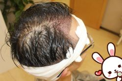 点击看大图 -大麦微针植发丨全国连锁