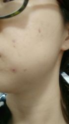 -苗方清颜·祛痘皮肤管理