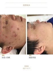 -塑青春&伊肤泉祛痘皮肤管理