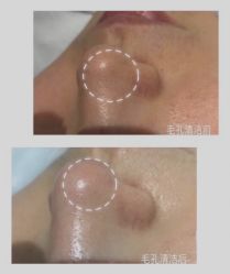 -美肤盾祛痘·问题肌头疗管理中心