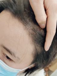 点击看大图 -碧莲盛·不剃发植发