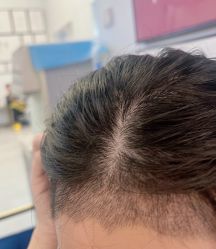 体验后-熙朵美学植发·连锁品牌