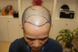 -大麦微针植发丨全国连锁