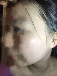 -美丽人生祛斑扁平疣汗管瘤中心