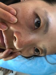 -美丽人生祛斑扁平疣汗管瘤中心