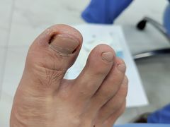 -Andrew指甲专科灰指甲·甲沟炎矫正·3D步态矫形鞋垫定制(浦三路店)