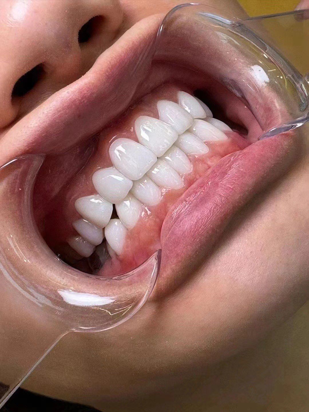 亮白牙齿自然闪耀