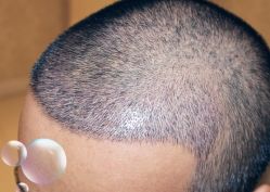 -大麦微针植发丨全国连锁