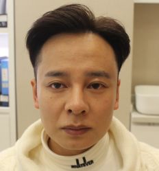 -大麦微针植发全国连锁