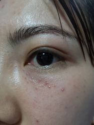 -爱莎扁平疣·汗管瘤·斑痣中心
