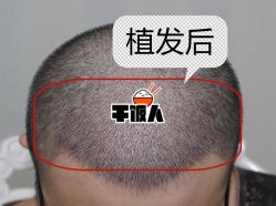 -大麦微针植发全国连锁