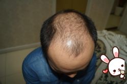 -大麦微针植发丨全国连锁