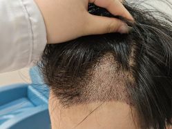 -大麦微针植发全国连锁