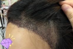 -大麦微针植发丨全国连锁