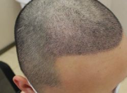 -大麦微针植发全国连锁