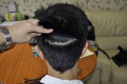 -大麦微针植发丨全国连锁