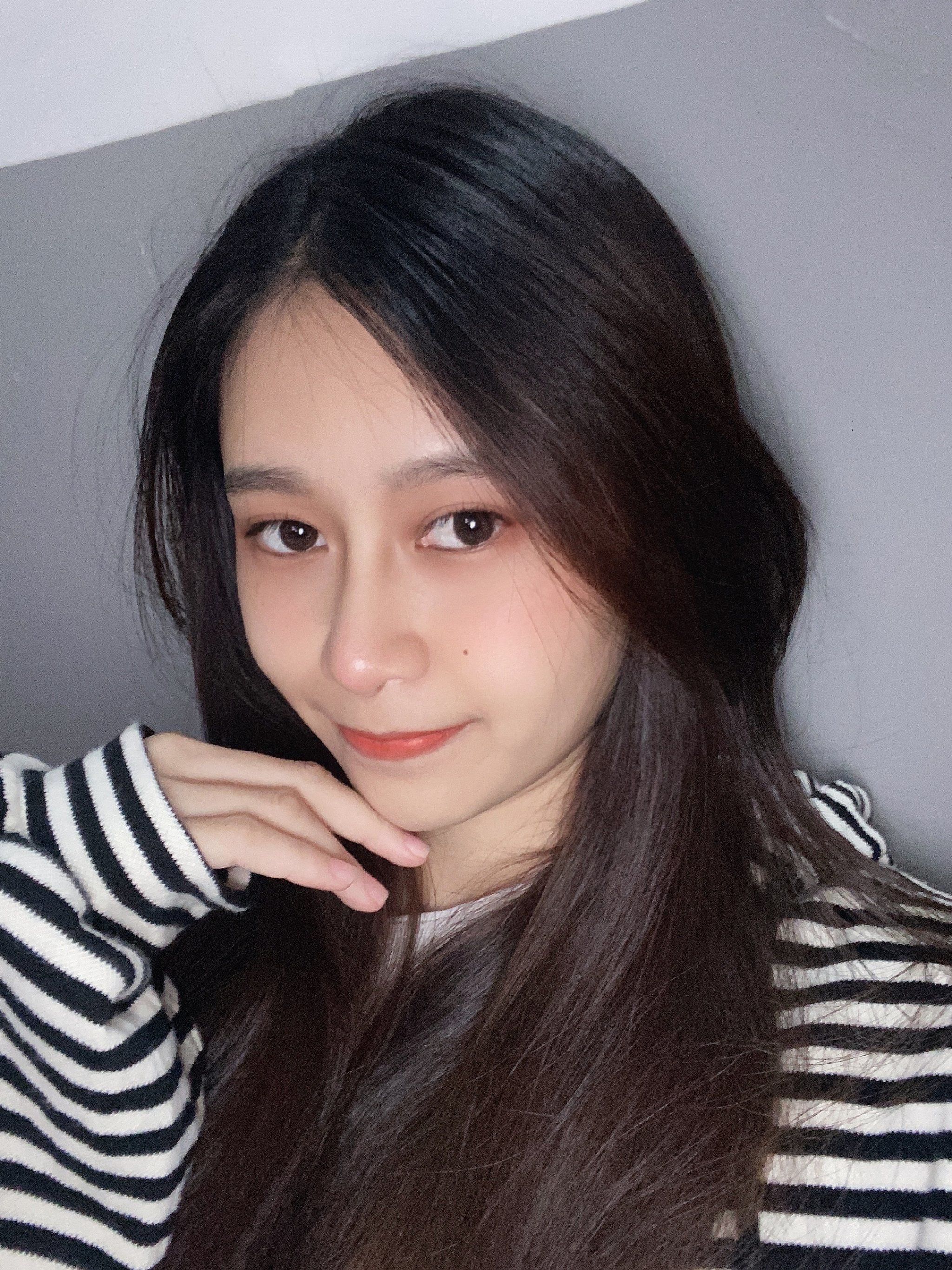 双侧耳软骨鼻综合术后第20天分享