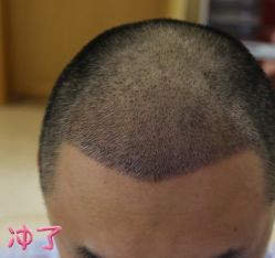 -大麦微针植发丨全国连锁