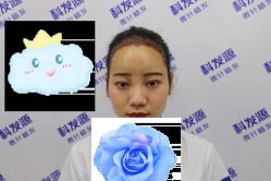 -大麦微针植发丨全国连锁
