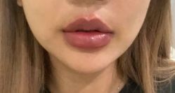 -海涛医疗美容·面部抗衰·注射美鼻