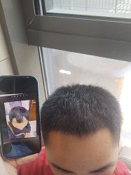 点击看大图 -碧莲盛·不剃发植发