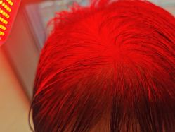 -碧莲盛·不剃发植发