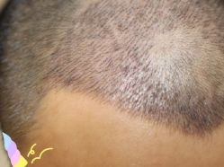 -大麦微针植发丨全国连锁