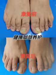 -德哥灰指甲脚气甲沟炎跖疣护理