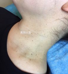 -爱莎扁平疣·汗管瘤·斑痣中心